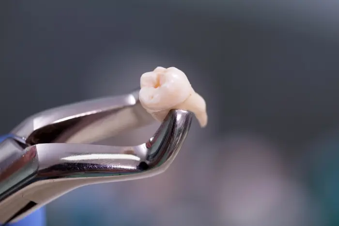 Preparing for Tooth Extraction and Aftercare